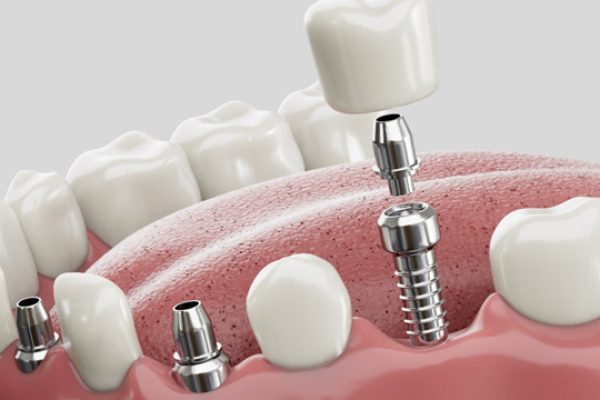 dental-implants-types